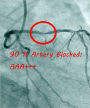 94% Artery Blockage ---AAA+++