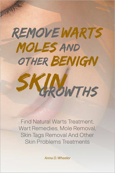 Remove Warts, Moles And Other Benign Skin Growths: Find Natural Warts