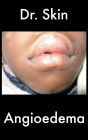 Angioedema