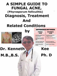 Title: A Simple Guide to Fungal Acne, (Pityrosporum folliculitis) Diagnosis, Treatment and Related Conditions, Author: Kenneth Kee