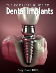 Title: The Complete Guide to Dental Implants (All About Dentistry), Author: Cary Ganz D.D.S.