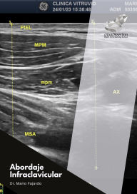 Title: Abordaje Infraclavicular, Author: Mario Fajardo