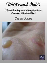 Title: Warts and Moles: Understanding and Managing these Common Skin Conditions, Author: Owen Jones