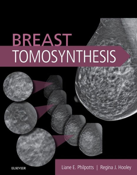 Breast Tomosynthesis