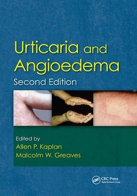 Urticaria and Angioedema / Edition 2