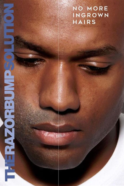 The Razor Bump Solution No More Ingrown Hairs By Al Washington