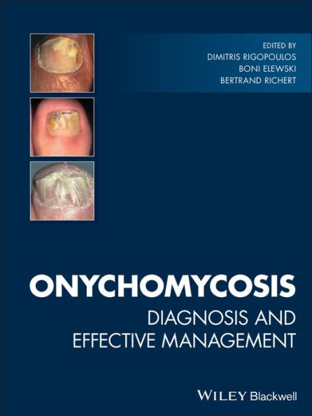 Onychomycosis: Diagnosis and Effective Management