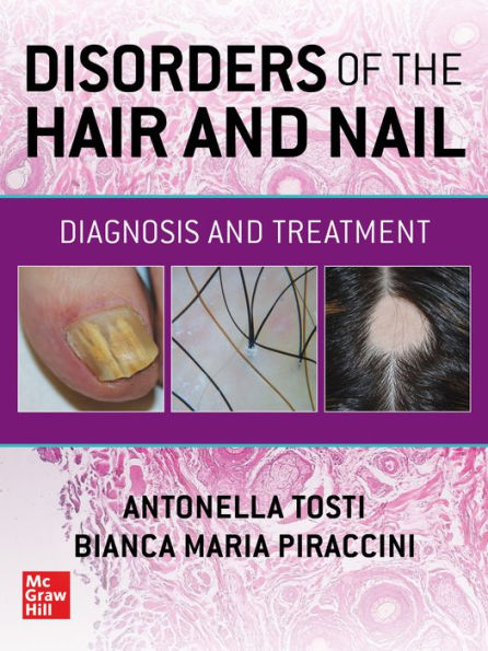 Disorders of the Hair and Nail: Diagnosis and Treatment