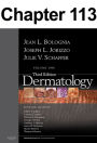 Melanoma: Chapter 113 of Dermatology