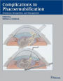 Complications in Phacoemulsification: Avoidance, Recognition, and Management