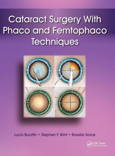 Cataract Surgery With Phaco and Femtophaco Techniques