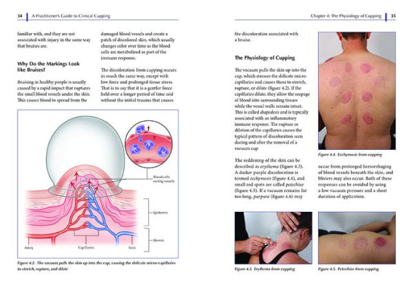 A Practitioner's Guide to Clinical Cupping: Effective Techniques for Pain Management and Injury