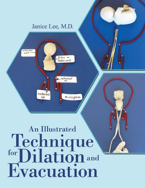 An Illustrated Technique For Dilation And Evacuation By Janice Lee Md Paperback Barnes And Noble®