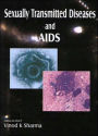 Sexually Transmitted Diseases and Aids