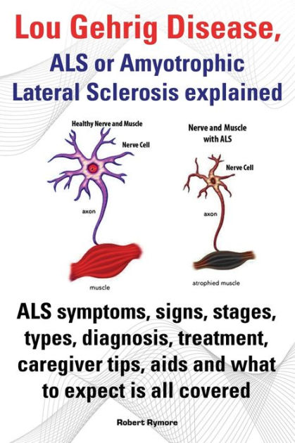 Lou Gehrig Disease, ALS Or Amyotrophic Lateral Sclerosis Explained. ALS ...