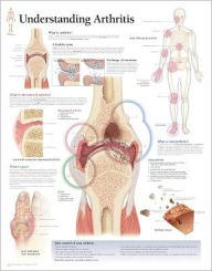 Understanding Arthritis chart