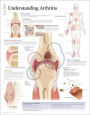 Understanding Arthritis chart