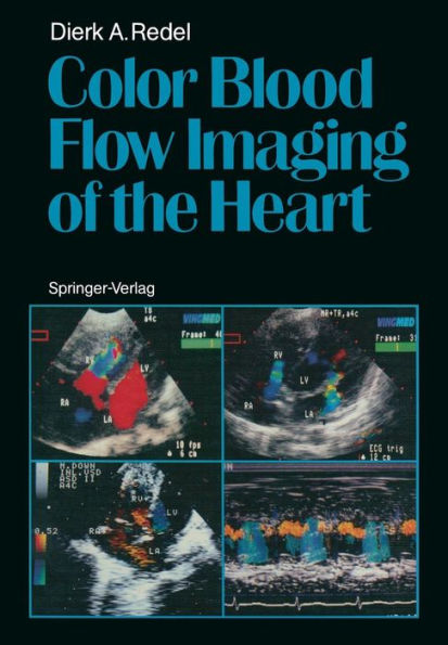 Color Blood Flow Imaging of the Heart