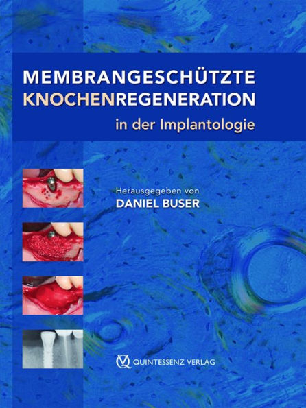 Membrangeschützte Knochenregeneration in der Implantologie