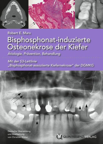 Bisphosphonat-induzierte Osteonekrose der Kiefer: Ätiologie, Prävention, Behandlung