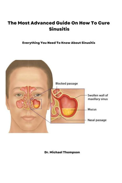 The Most Advanced Guide On How To Cure Sinusitis Everything You Need