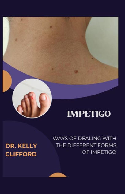 Impetigo: Ways Of Dealing With The Different Forms Of Impetigo By Dr 