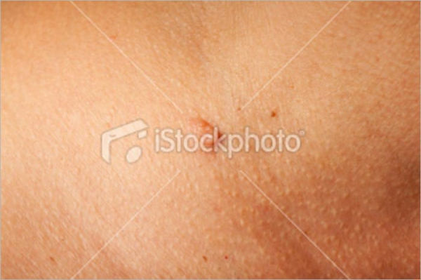 Debunking Warts: The Myths, the Real Causes and the Treatments