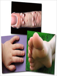Title: Natural Home Remedies For Wart Removal Solutions, Author: Ana Robbins