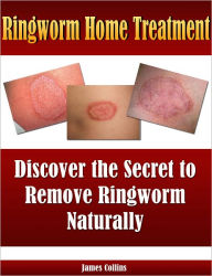 Title: Ringworm Home Treatment: Discover the Secret to Remove Ringworm Naturally, Author: James Collins
