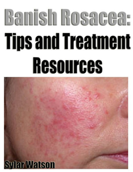 Banish Rosacea: Tips and Treatment Resources