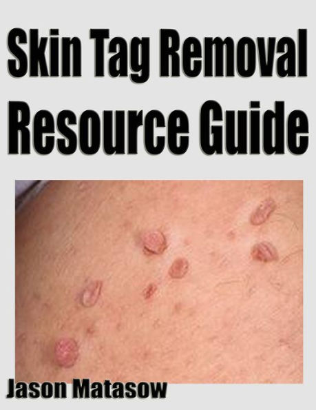 Skin Tag Removal Resource Guide