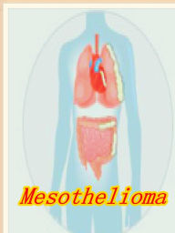 Title: Mesothelioma, Author: Alan Smith