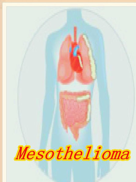 Mesothelioma