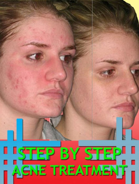 Step By Step Acne Treatment