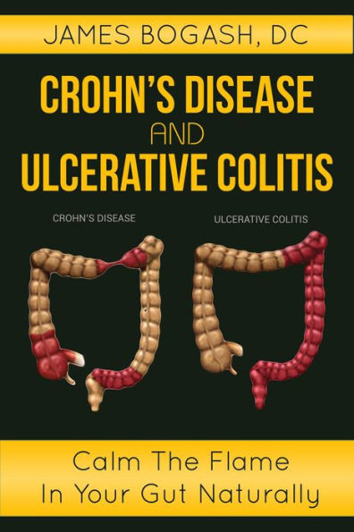 Crohn's Disease and Ulcerative Colitis: Calm the Flame in Your Gut Naturally