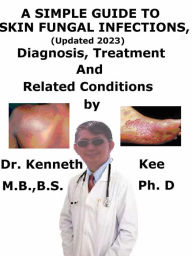 Title: A Simple Guide to Skin Fungal Infections, (Updated 2023) Diagnosis, Treatment and Related Conditions, Author: Kenneth Kee