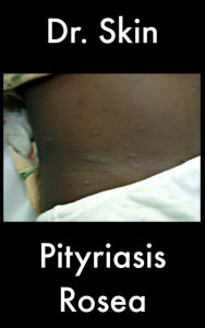 Title: Pityriasis Rosea, Author: Dr Skin