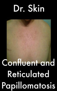 Title: Confluent and Reticulated Papillomatosis, Author: Dr Skin