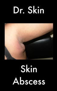 Title: Skin Abscess, Author: Dr Skin