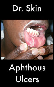 Title: Aphthous Ulcers, Author: Dr Skin