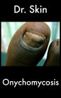 Onychomycosis