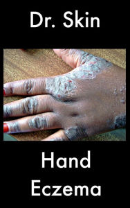 Title: Hand Eczema, Author: Dr Skin