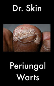 Title: Periungal Warts, Author: Dr Skin