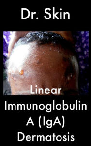 Title: Linear Immunoglobulin A Dermatosis, Author: Dr Skin