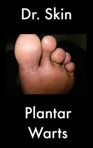 Title: Plantar Warts, Author: Dr Skin