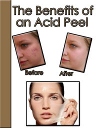 Title: The Benefits of an Acid Peel, Author: Tonya Alves