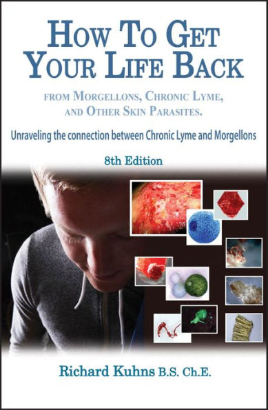 How To Get Your Life Back From Morgellons and Other Skin Parasites