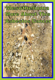 Title: Best of the Sellers Mesothelioma More About This Asbestos Cancer ( exercise, meditation, acupuncture, disease, digestive system, formula, medicine, remedy, fix, treatment, action, conduct, behavior, handling, gastrin, fitness, vitamins, healing, diet ), Author: Resounding Wind Publishing