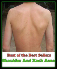 Title: Skincare: Shoulder And Back Acne (blackheads,pimples,pustules, zits, whiteheads, skin inflammation, pizza face, tumor, eruption), Author: Blackhead Treatment