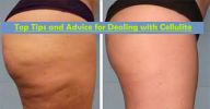 Title: Top Tips and Advice for Dealing with Cellulite, Author: Christopher McNeil